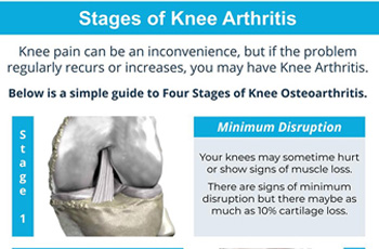 Four Stages of Knee Arthritis