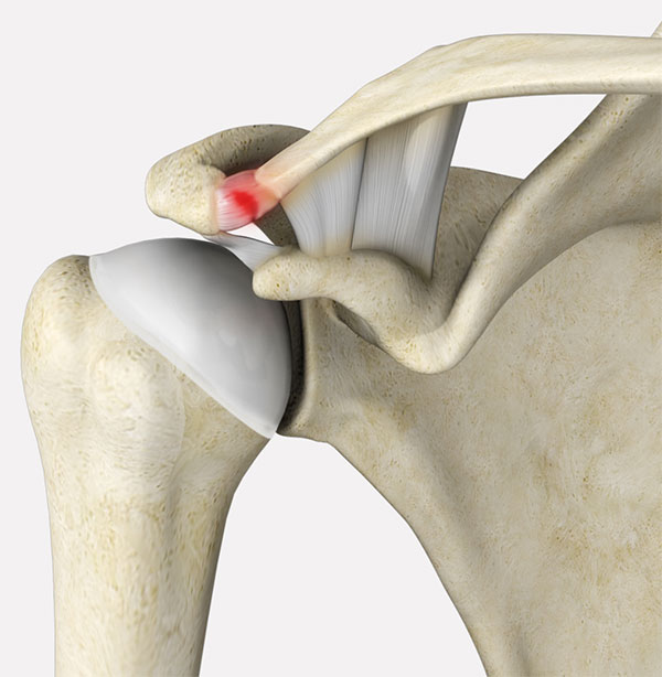 AC Joint Dislocation: Types, Symptoms, and Treatment