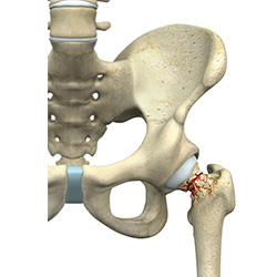 Nondisplaced Femoral Neck Fragility Fracture