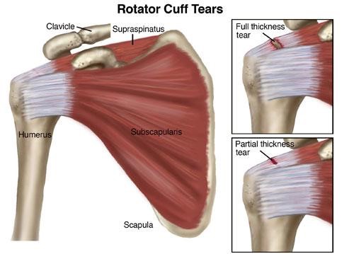 Guide to Rotator Cuff Tear