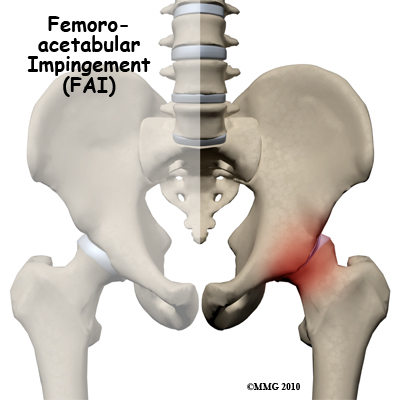 femoroacetabular impingement (FAI) illustration