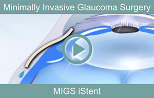 Minimally Invasive Glaucoma Surgery 