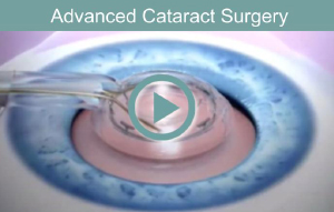 Advanced Cataract Surgery with Zepto