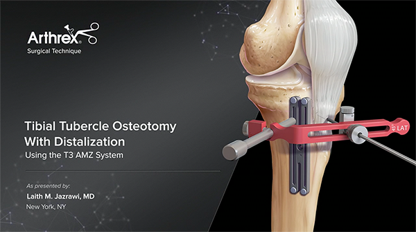 Tibial Tubercle Osteotomy
