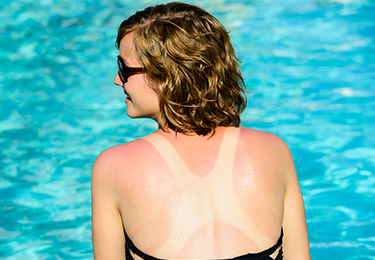 Do Sunburns Really Cause Cancer?