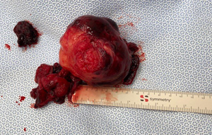 Evulsion of a Large Fibroid