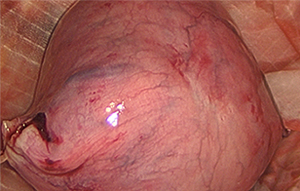 Abdominal Pain with Large Uterine AdenomyosisLaparoscopic Subtotal Hysterectomy and Morcellation of a Fibroid Uterus and Espiner Bag