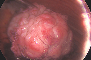 Laparoscopic Hysterectomy for a large fibroid uterus