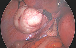 Laparoscopic Subtotal Hysterectomy for a Large Fibroid Uterus
