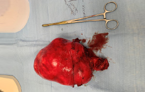 Large Fibroid Uterus