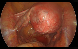 Abdominal Pain with Large Uterine Adenomyosis