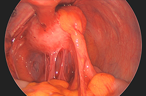 Laparoscopic Removal of Fibroid (Myomectomy)