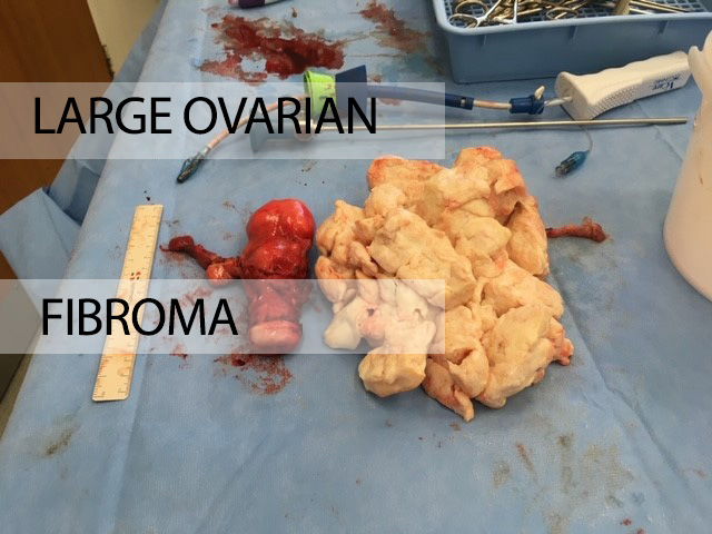 Large Ovarian Fibroma
