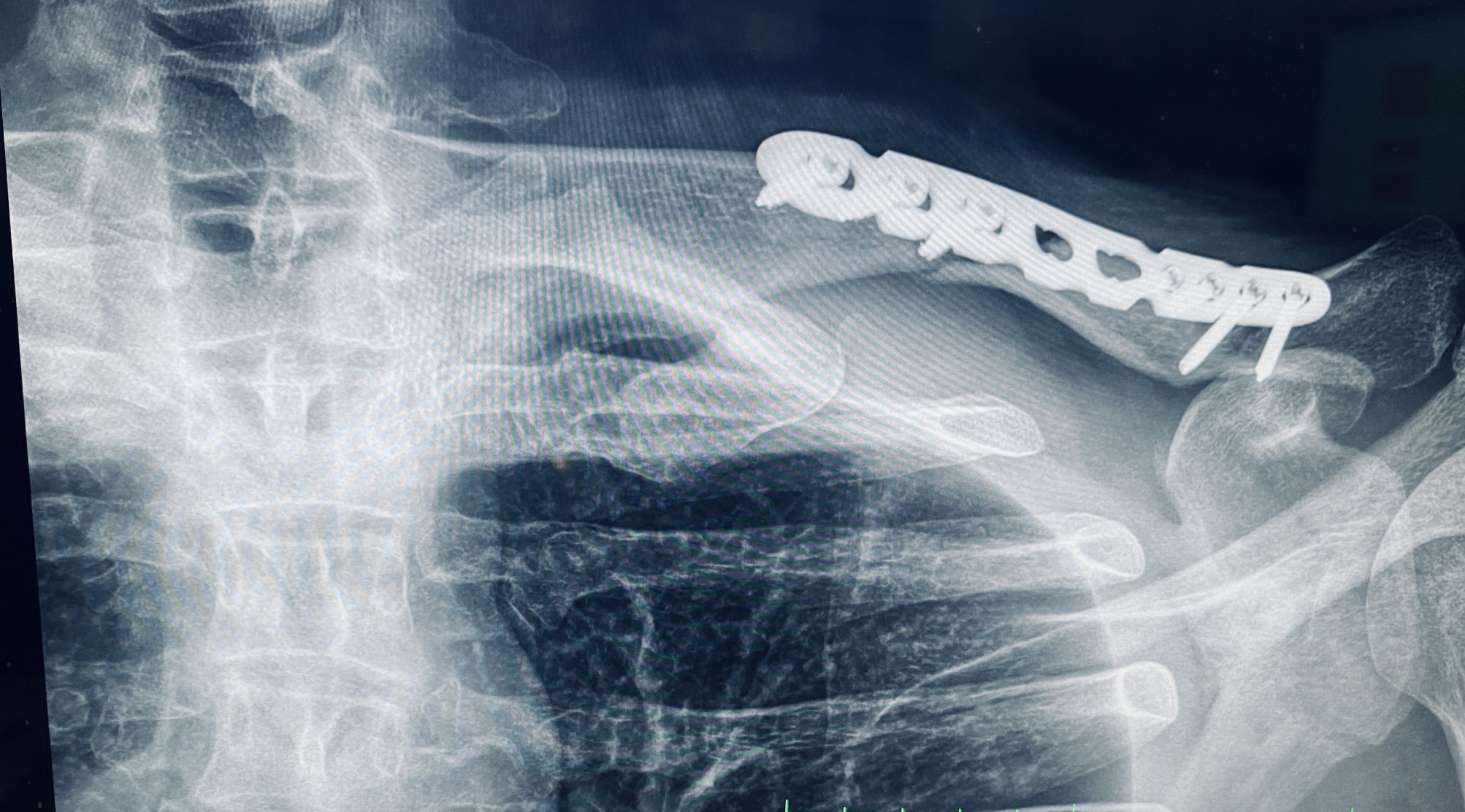 x-ray of a shoulder bone