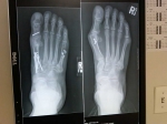 Foot Injury/Condition